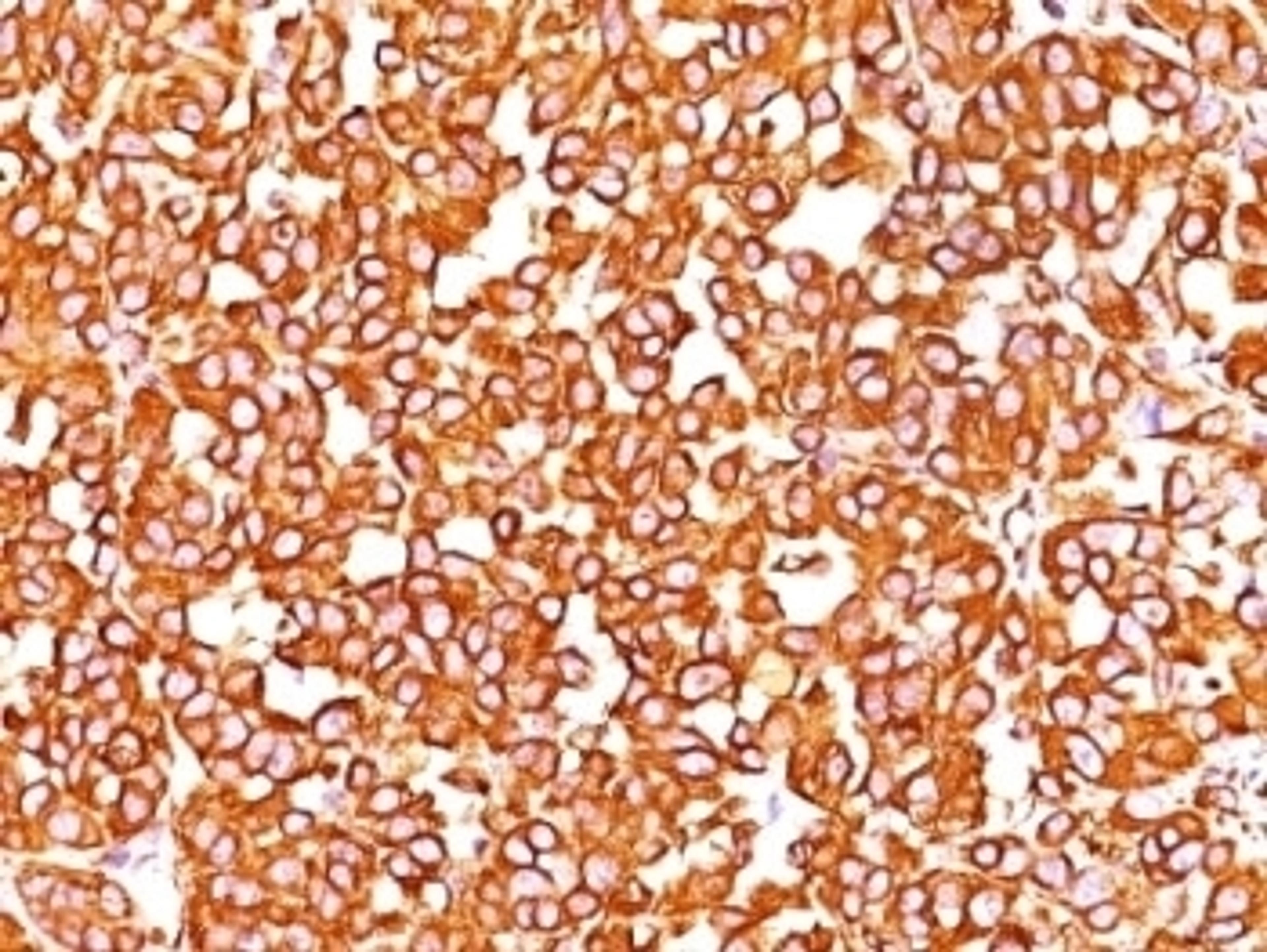 Formalin-fixed, paraffin-embedded human melanoma stained with VIM antibody (SPM576).