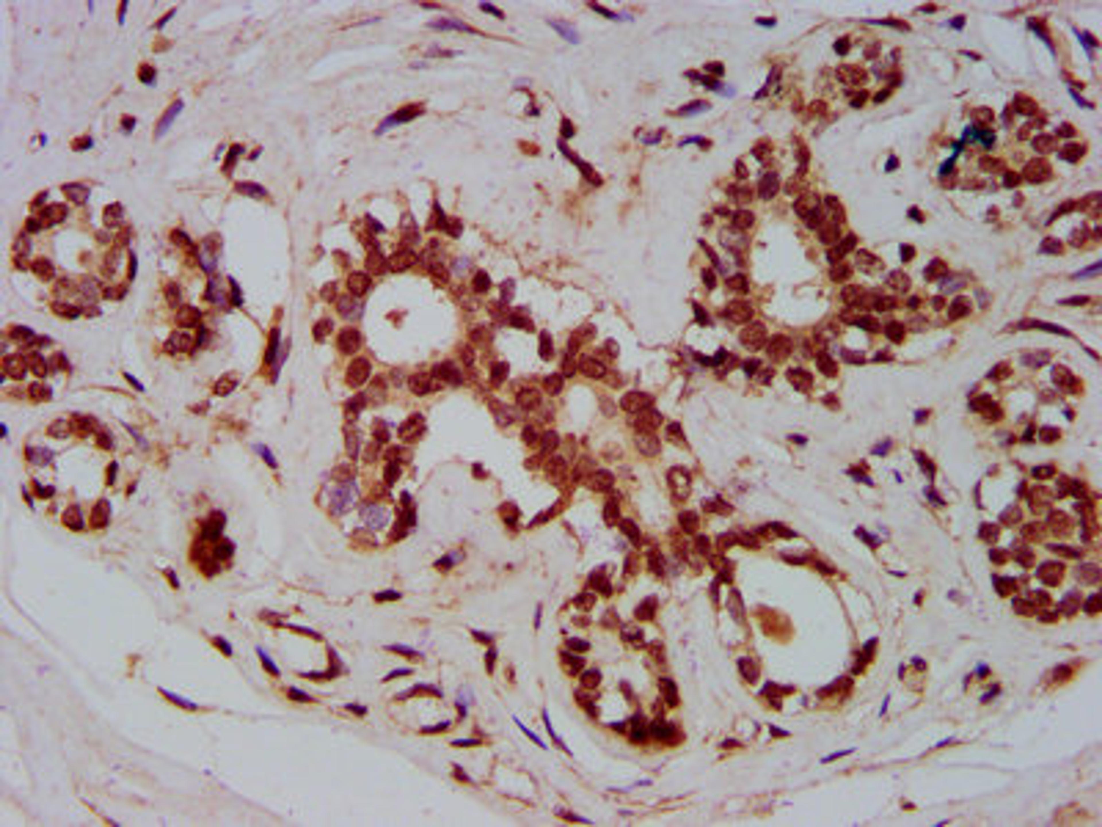 IHC image of CSB-PA890749LA01HU diluted at 1:800 and staining in paraffin-embedded human breast cancer performed on a Leica BondTM system. After dewaxing and hydration, antigen retrieval was mediated by high pressure in a citrate buffer (pH 6.0). Section was blocked with 10% normal goat serum 30min at RT. Then primary antibody (1% BSA) was incubated at 4&deg;C overnight. The primary is detected by a biotinylated secondary antibody and visualized using an HRP conjugated SP system.