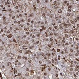 Immunohistochemistry: TBL1Y Antibody [NBP2-32513] - liver cancer