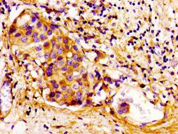 Immunohistochemistry of paraffin-embedded human breast cancer using CSB-PA005096LA01HU at dilution of 1:100
