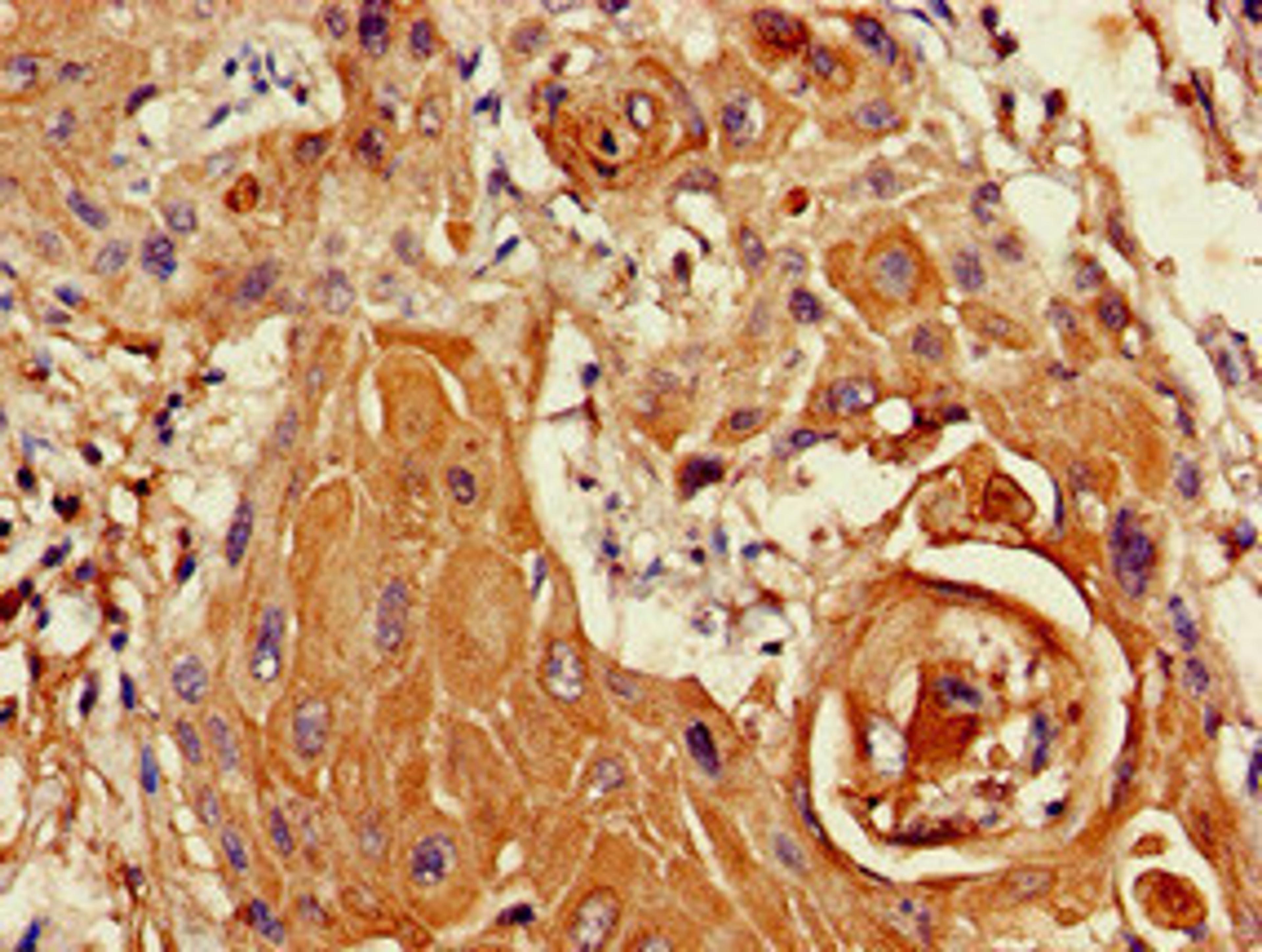 Immunohistochemistry of paraffin-embedded human cervical cancer using CSB-PA871633LA01HU at dilution of 1:100