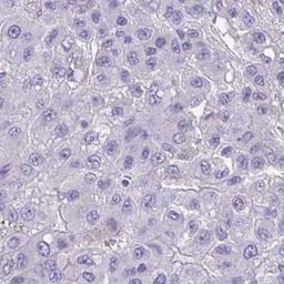 Immunohistochemistry: HOXC12 Antibody [NBP2-31608] - liver cancer