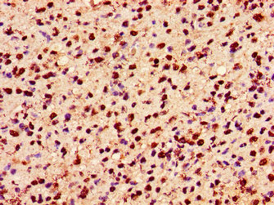 Immunohistochemistry of paraffin-embedded human glioma using CSB-PA010389PA36ncrHU at dilution of 1:100