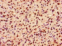 Immunohistochemistry of paraffin-embedded human glioma using CSB-PA010389PA36ncrHU at dilution of 1:100