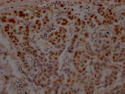 IHC image of CSB-RA214807A0HU diluted at 1:100 and staining in paraffin-embedded human breast cancer performed on a Leica BondTM system. After dewaxing and hydration, antigen retrieval was mediated by high pressure in a citrate buffer (pH 6.0). Section was blocked with 10% normal goat serum 30min at RT. Then primary antibody (1% BSA) was incubated at 4℃ overnight. The primary is detected by a Goat anti-rabbit IgG polymer labeled by HRP and visualized using 0.05% DAB.
