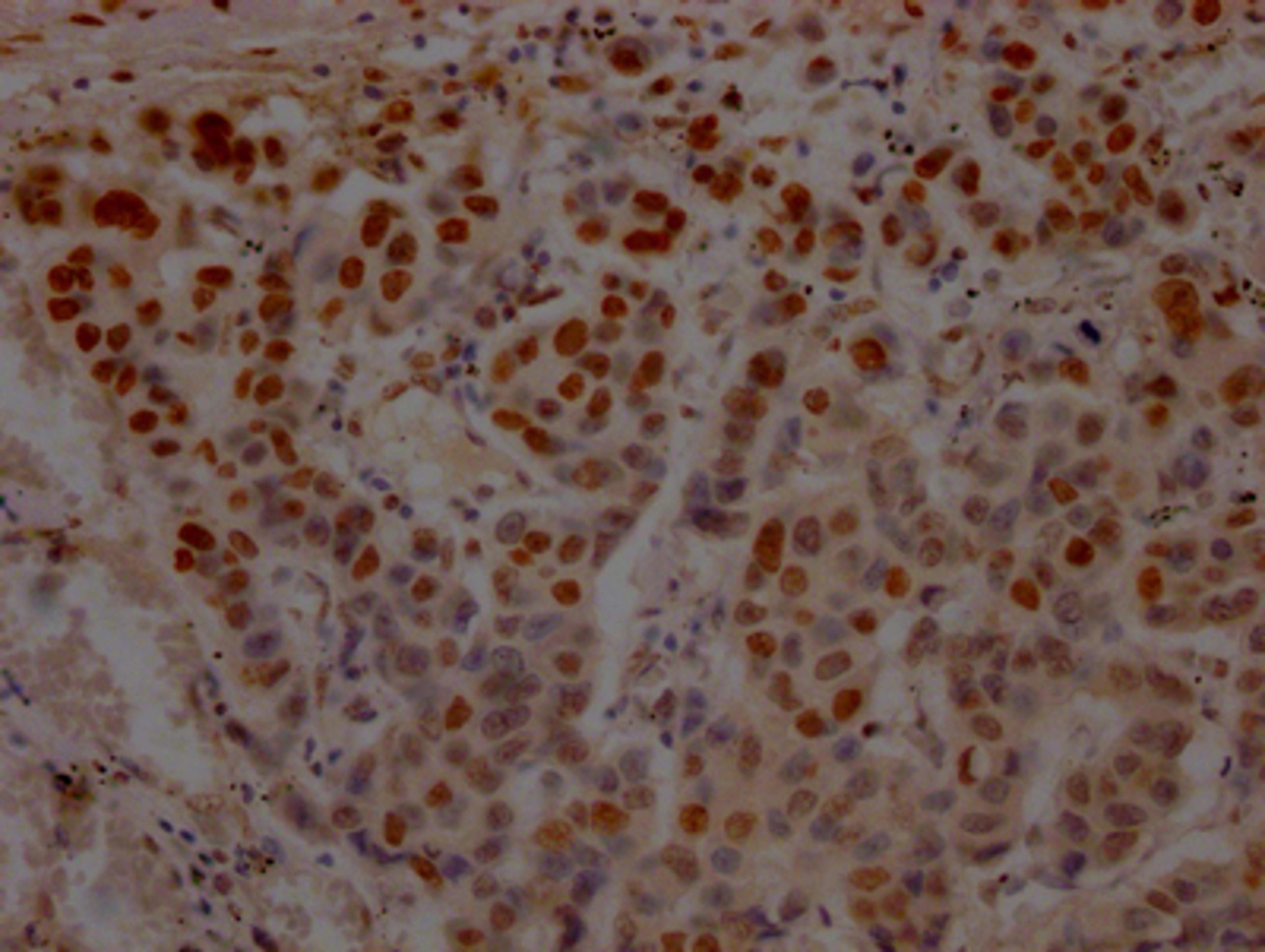 IHC image of CSB-RA214807A0HU diluted at 1:100 and staining in paraffin-embedded human breast cancer performed on a Leica BondTM system. After dewaxing and hydration, antigen retrieval was mediated by high pressure in a citrate buffer (pH 6.0). Section was blocked with 10% normal goat serum 30min at RT. Then primary antibody (1% BSA) was incubated at 4℃ overnight. The primary is detected by a Goat anti-rabbit IgG polymer labeled by HRP and visualized using 0.05% DAB.