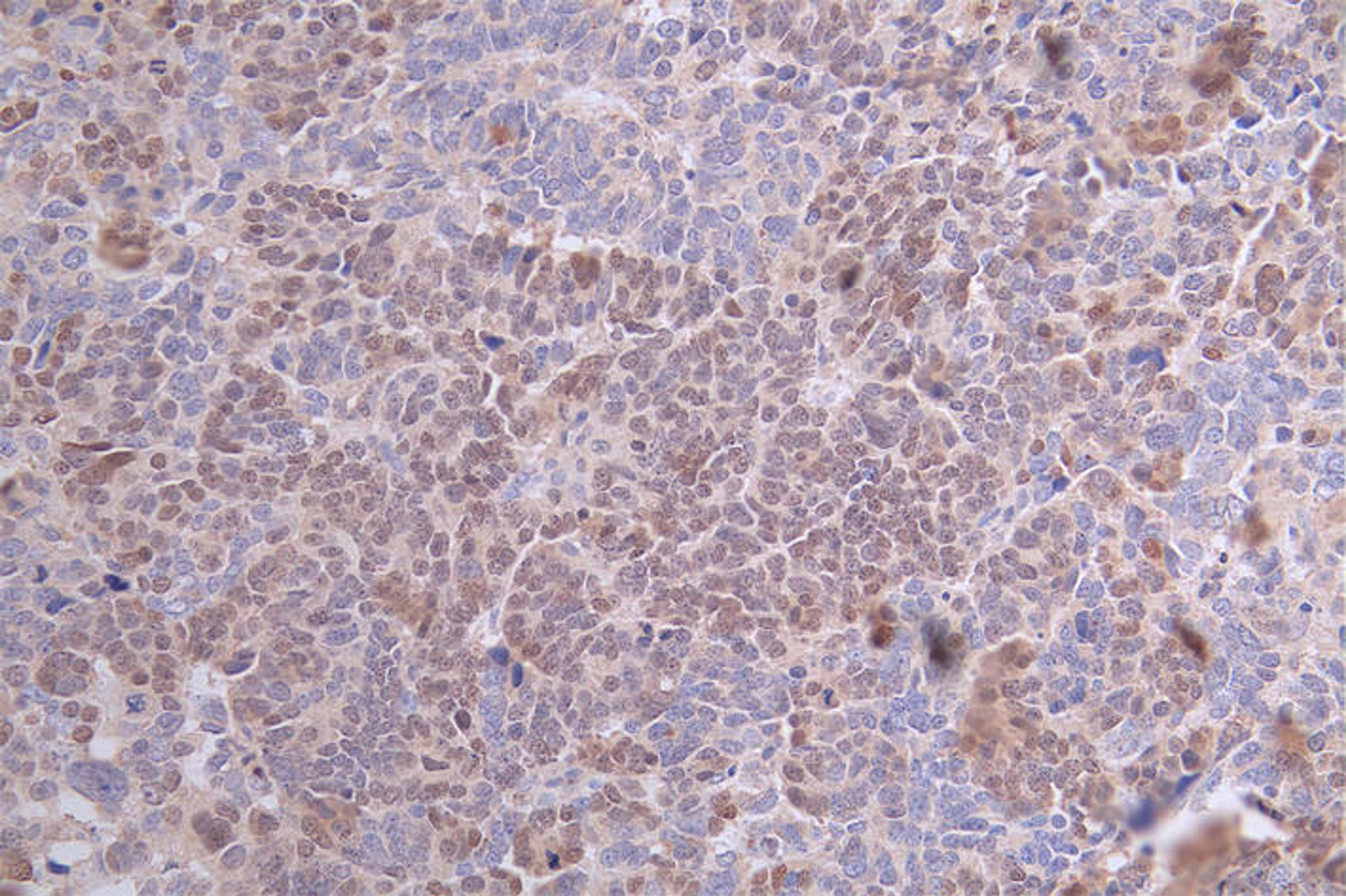 IHC image of CSB-RA24801:50A0HU diluted at 1:100 and staining in paraffin-embedded human ovarian cancer performed on a Leica BondTM system. After dewaxing and hydration, antigen retrieval was mediated by high pressure in a citrate buffer (pH 6.0). Section was blocked with 10% normal goat serum 30min at RT. Then primary antibody (1% BSA) was incubated at 4°C overnight. The primary is detected by a Goat anti-rabbit polymer IgG labeled by HRP and visualized using 0.59% DAB.