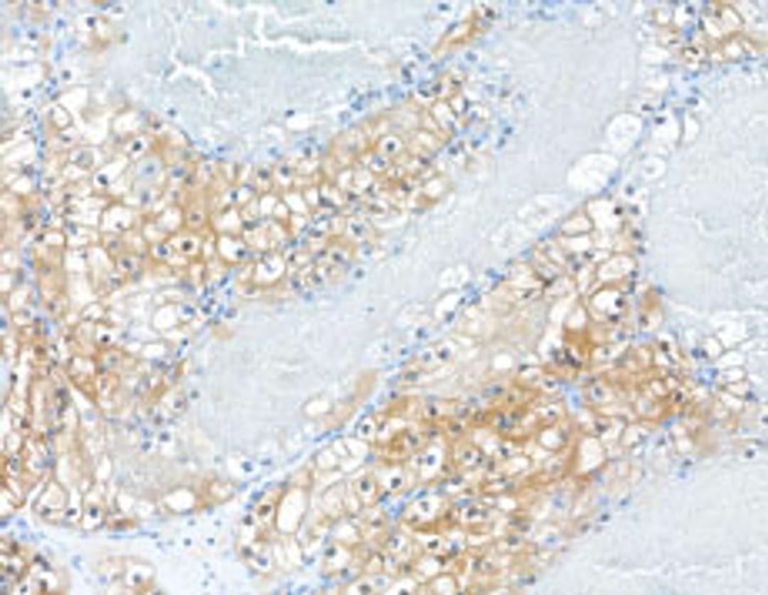 Detection of human MIF in FFPE renal cell carcinoma by immunohistochemistry.