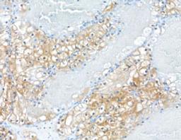 Detection of human MIF in FFPE renal cell carcinoma by immunohistochemistry.