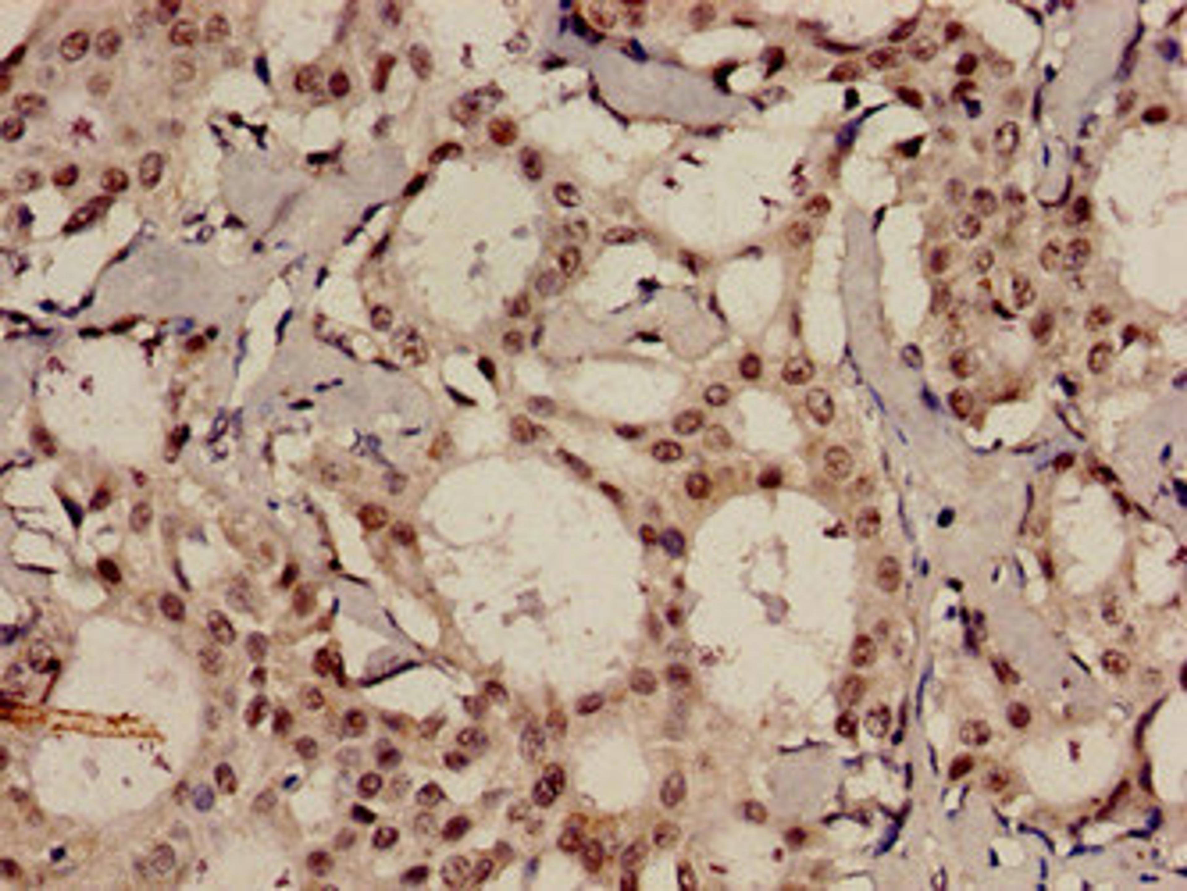 Immunohistochemistry analysis of human breast cancer using CSB-PA623929LA01HU at dilution of 1:100