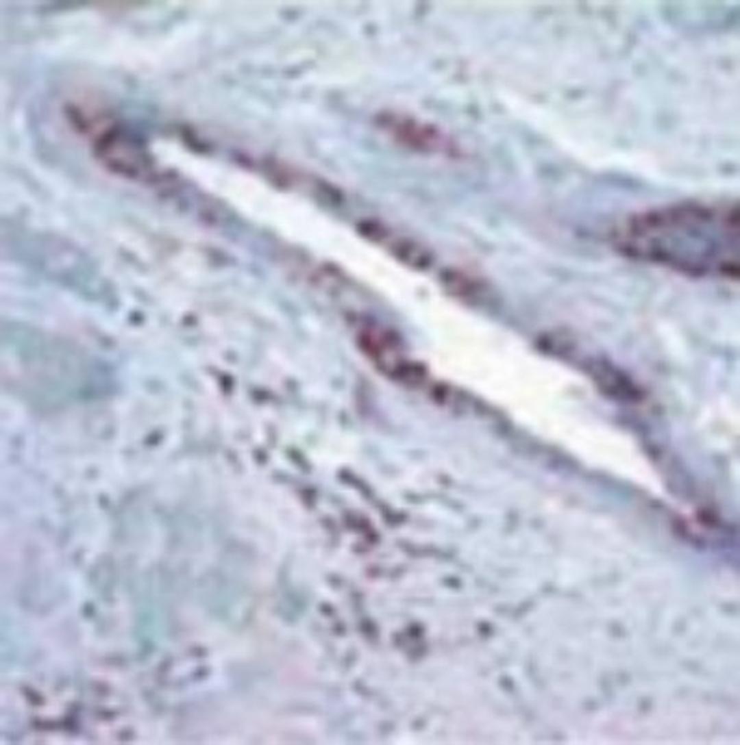 Immunohistochemistry: cleaved Retinoblastoma 1 Antibody (172C1094) [NB100-56598] - IHC of DRb-p70 in sections of primary human breast tumors. Image courtesy of Dr. Macleod, The Ben May Institute for Cancer Research, The University of Chicago.