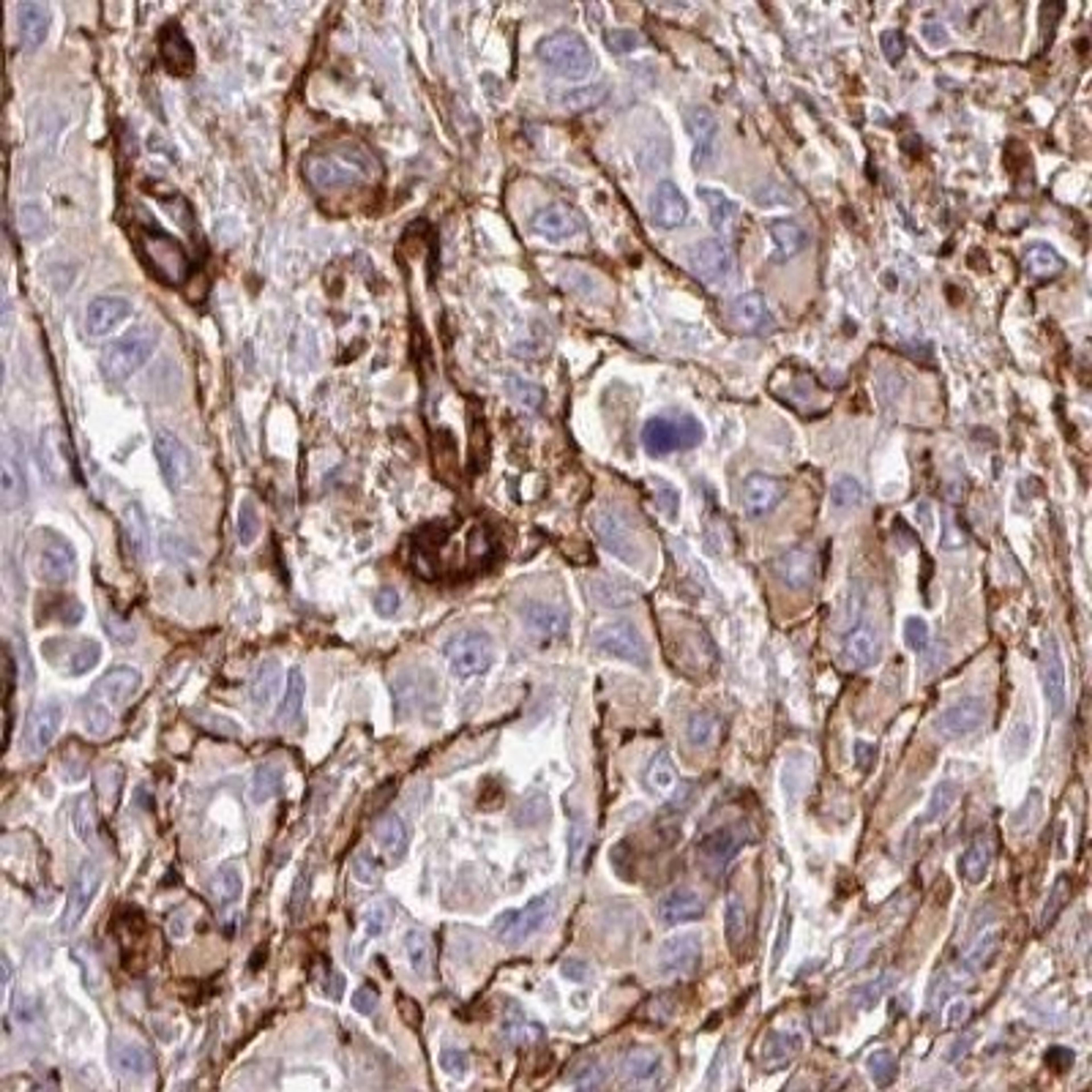 Immunohistochemistry: LOXL4 Antibody [NBP2-32692] - liver cancer