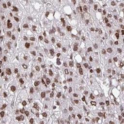 Immunohistochemistry: LYDG10 Antibody [NBP2-31849] - liver cancer