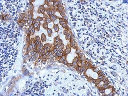 Immunohistochemistry-Paraffin: IL1RAP Antibody [NBP2-16946] - Immunohistochemical analysis of paraffin-embedded Breast ca, using antibody at 1:500 dilution.