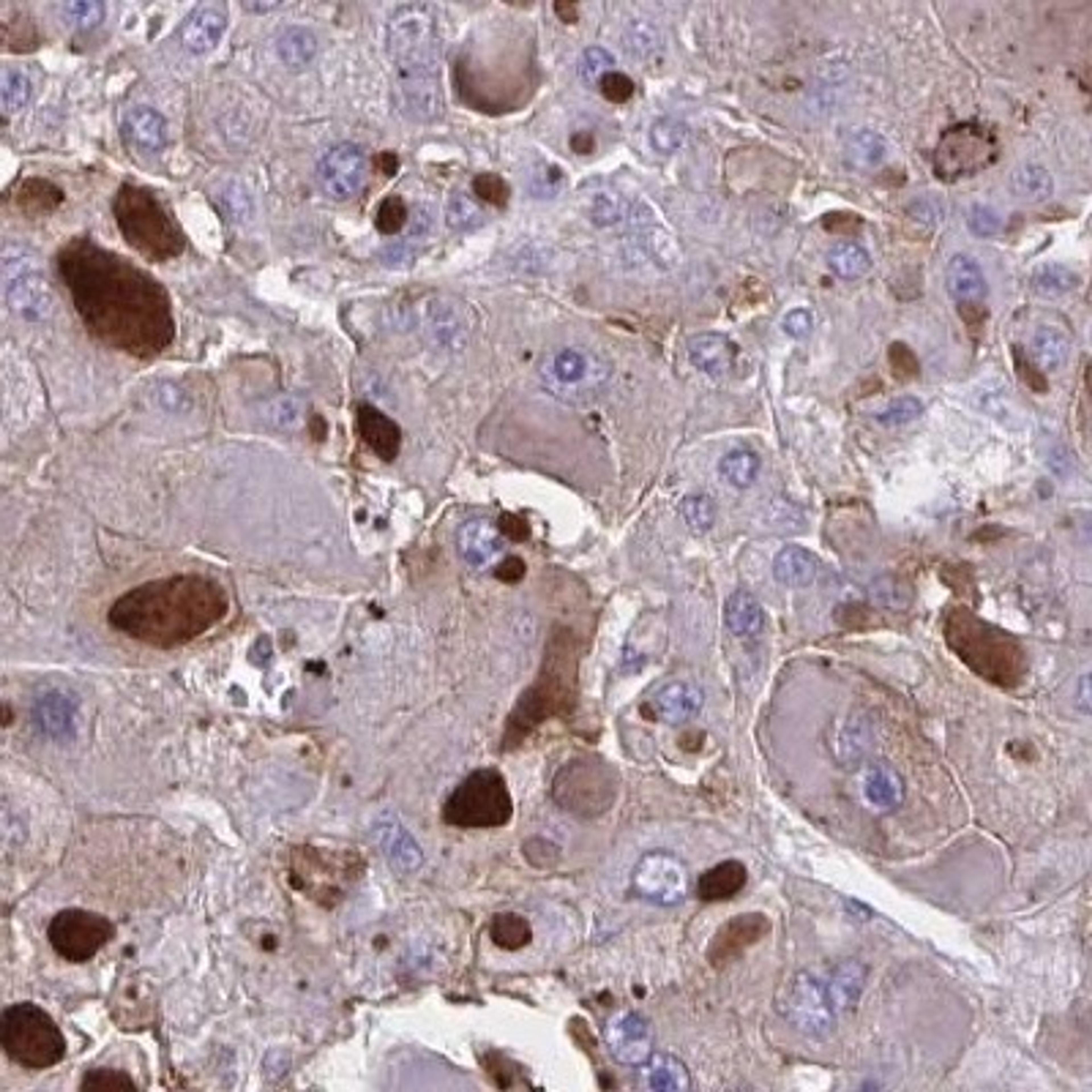 Immunohistochemistry: OR51M1 Antibody [NBP2-31649] - liver cancer