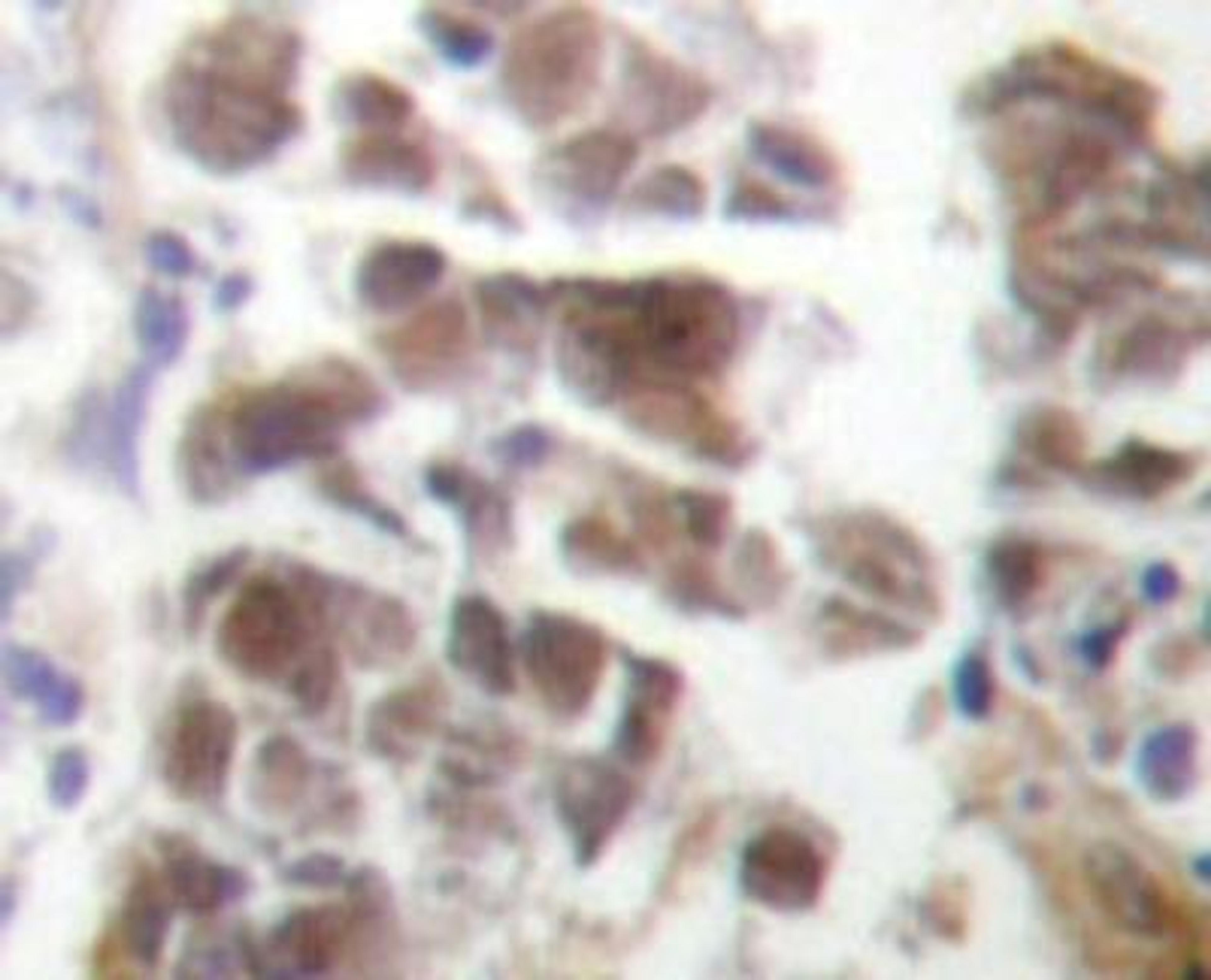 Immunohistochemistry-Paraffin: GATA-4 Antibody [NBP1-19461] - Paraffin-embedded human lung carcinoma tissue.