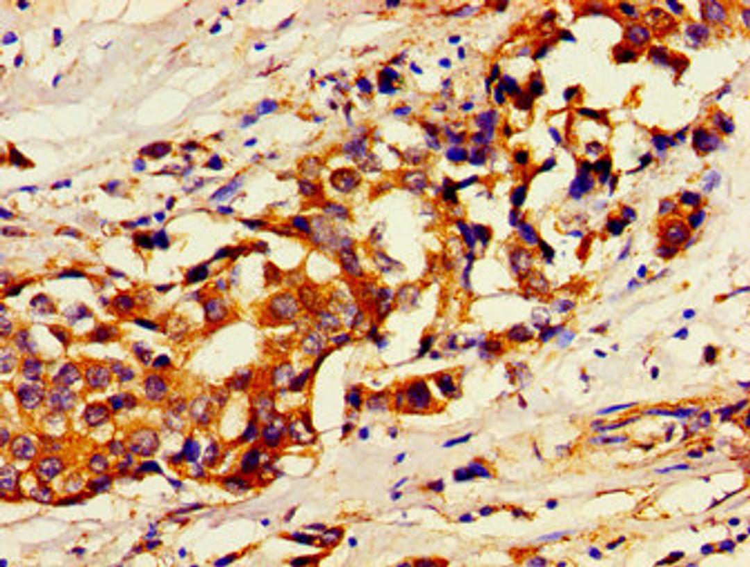 Immunohistochemistry of paraffin-embedded human breast cancer using CSB-PA849973LA01HU at dilution of 1:100