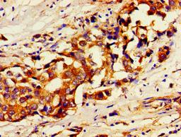 Immunohistochemistry of paraffin-embedded human breast cancer using CSB-PA849973LA01HU at dilution of 1:100