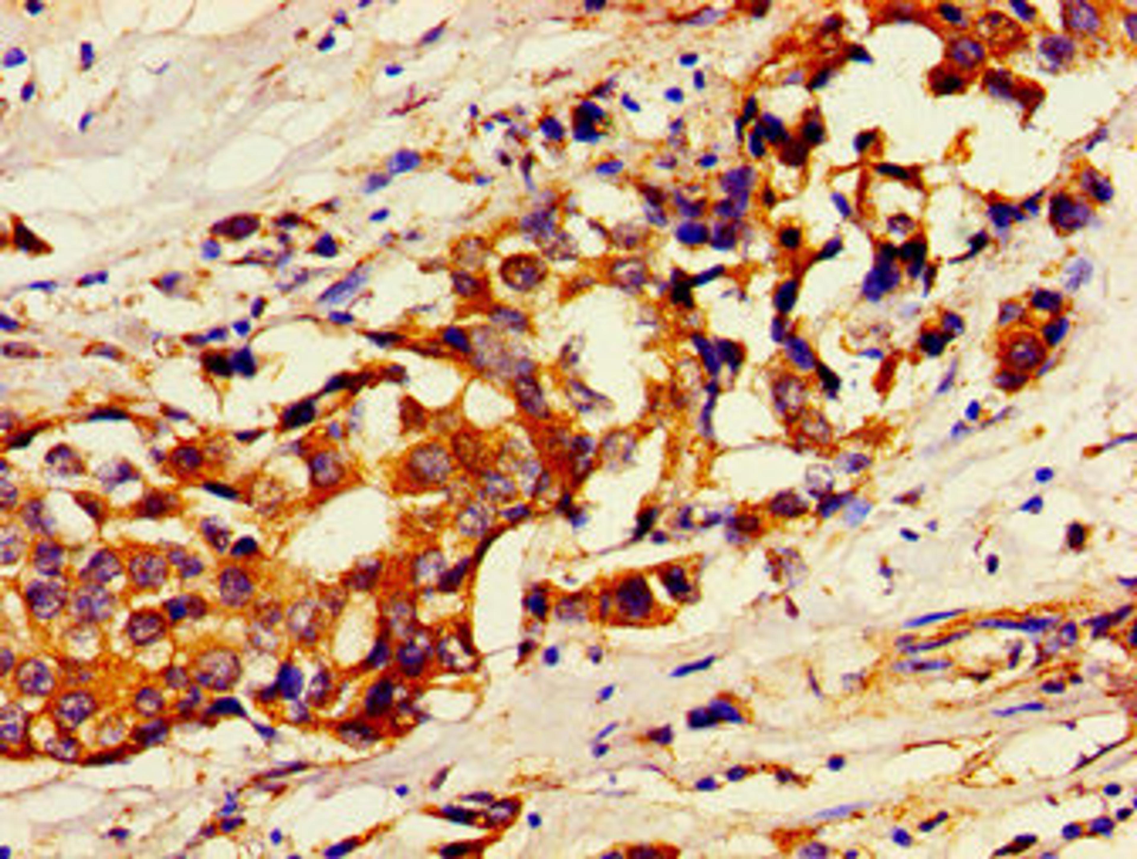 Immunohistochemistry of paraffin-embedded human breast cancer using CSB-PA849973LA01HU at dilution of 1:100