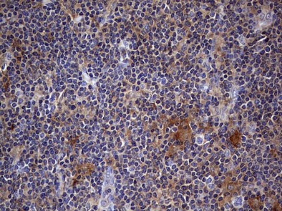 Immunohistochemistry: Kynureninase Antibody (1H1) [NBP2-45579] - Analysis of Human lymphoma tissue.