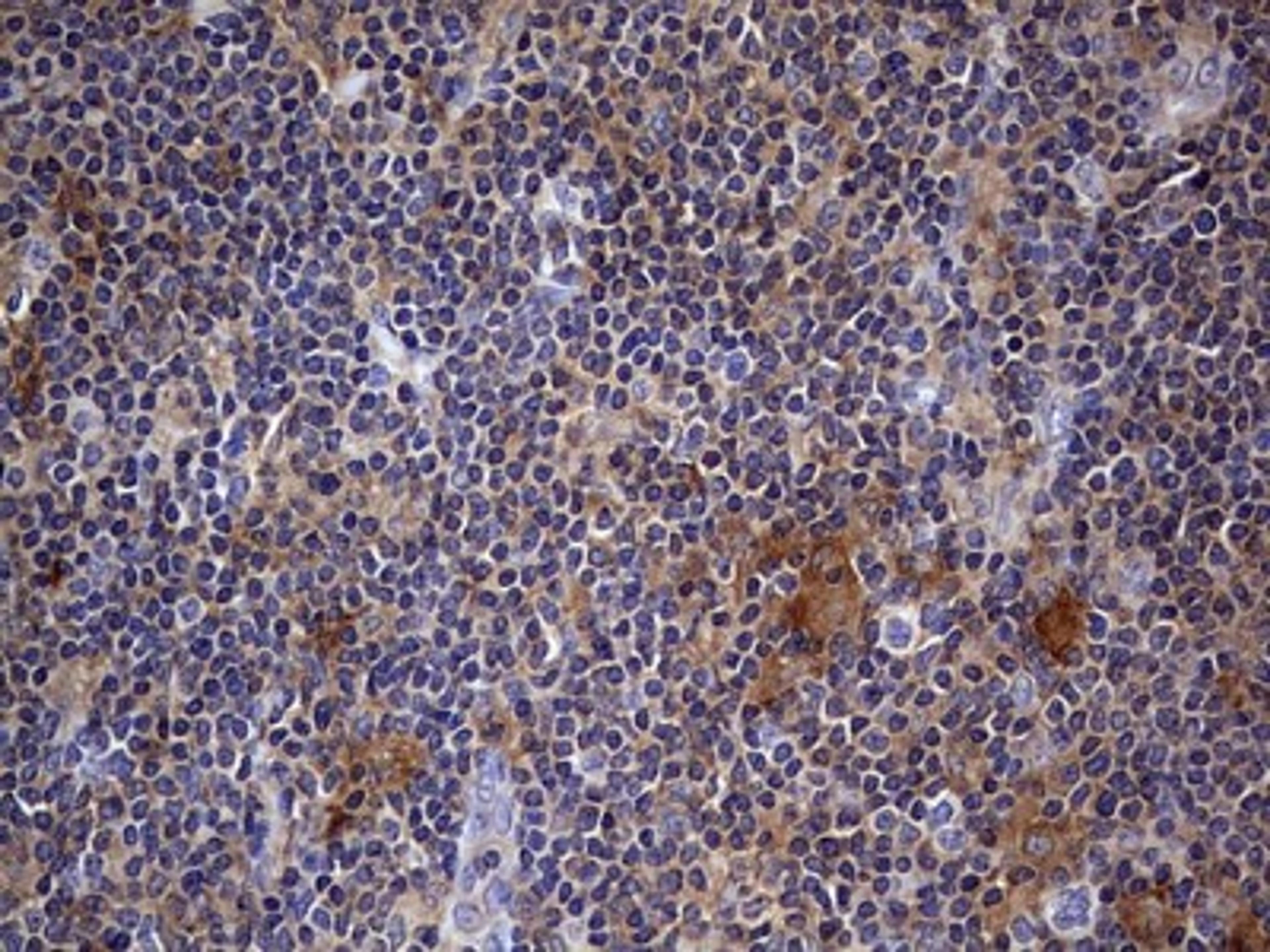 Immunohistochemistry: Kynureninase Antibody (1H1) [NBP2-45579] - Analysis of Human lymphoma tissue.