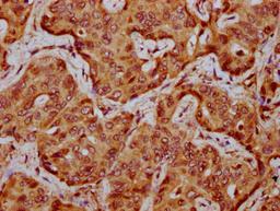 IHC image of CSB-PA025865LA01HU diluted at 1:300 and staining in paraffin-embedded human liver cancer performed on a Leica BondTM system. After dewaxing and hydration, antigen retrieval was mediated by high pressure in a citrate buffer (pH 6.0). Section was blocked with 10% normal goat serum 30min at RT. Then primary antibody (1% BSA) was incubated at 4&deg;C overnight. The primary is detected by a biotinylated secondary antibody and visualized using an HRP conjugated SP system.