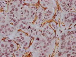 IHC image of CSB-MA918107 diluted at 1:100 and staining in paraffin-embedded human liver cancer performed on a Leica BondTM system. After dewaxing and hydration, antigen retrieval was mediated by high pressure in a citrate buffer (pH 6.0). Section was blocked with 10% normal goat serum 30min at RT. Then primary antibody (1% BSA) was incubated at 4°C overnight. The primary is detected by a Goat anti-mouse IgG polymer labeled by HRP and visualized using 0.05% DAB.