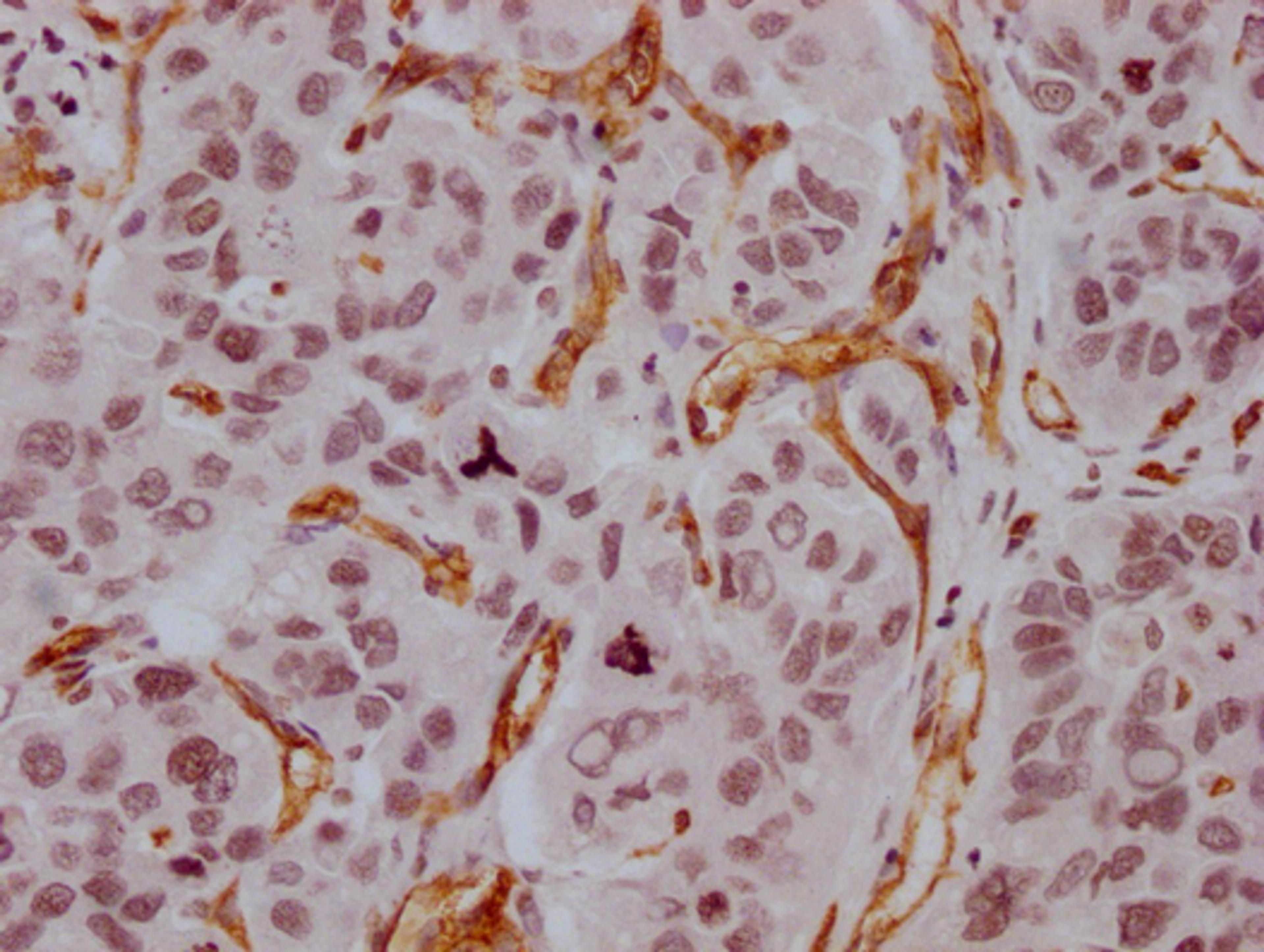 IHC image of CSB-MA918107 diluted at 1:100 and staining in paraffin-embedded human liver cancer performed on a Leica BondTM system. After dewaxing and hydration, antigen retrieval was mediated by high pressure in a citrate buffer (pH 6.0). Section was blocked with 10% normal goat serum 30min at RT. Then primary antibody (1% BSA) was incubated at 4°C overnight. The primary is detected by a Goat anti-mouse IgG polymer labeled by HRP and visualized using 0.05% DAB.