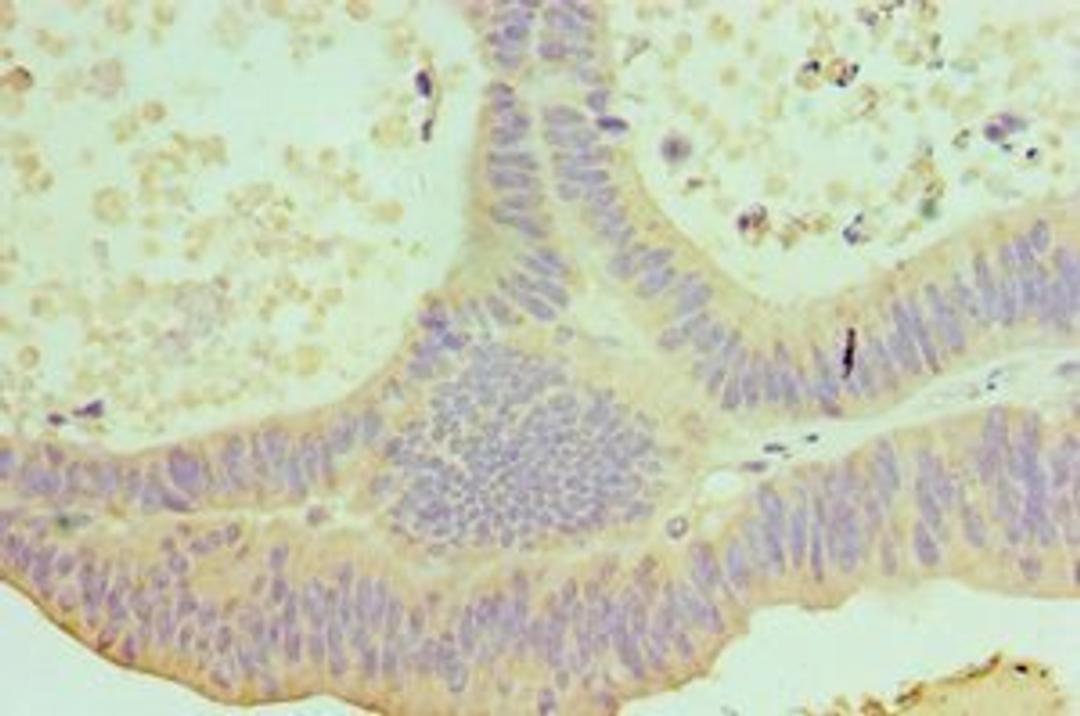 Immunohistochemical staining of human colon cancer using IL22 antibody