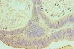 Immunohistochemical staining of human colon cancer using IL22 antibody