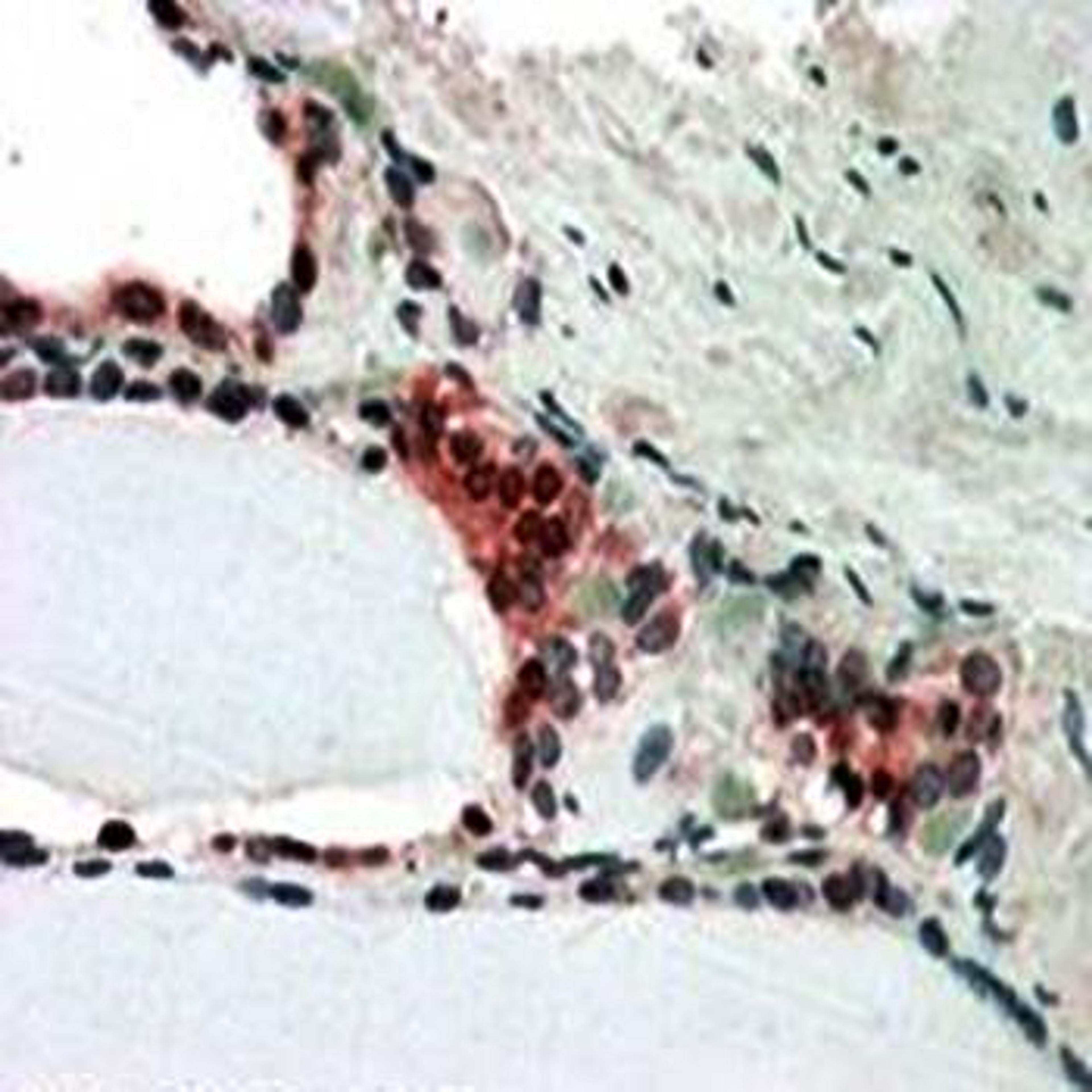 Immunohistochemical analysis of formalin-fixed and paraffin embedded Human Thyroid Gland shows nclear and cytoplasm (3-5ug/ml) using CSN2 antibody