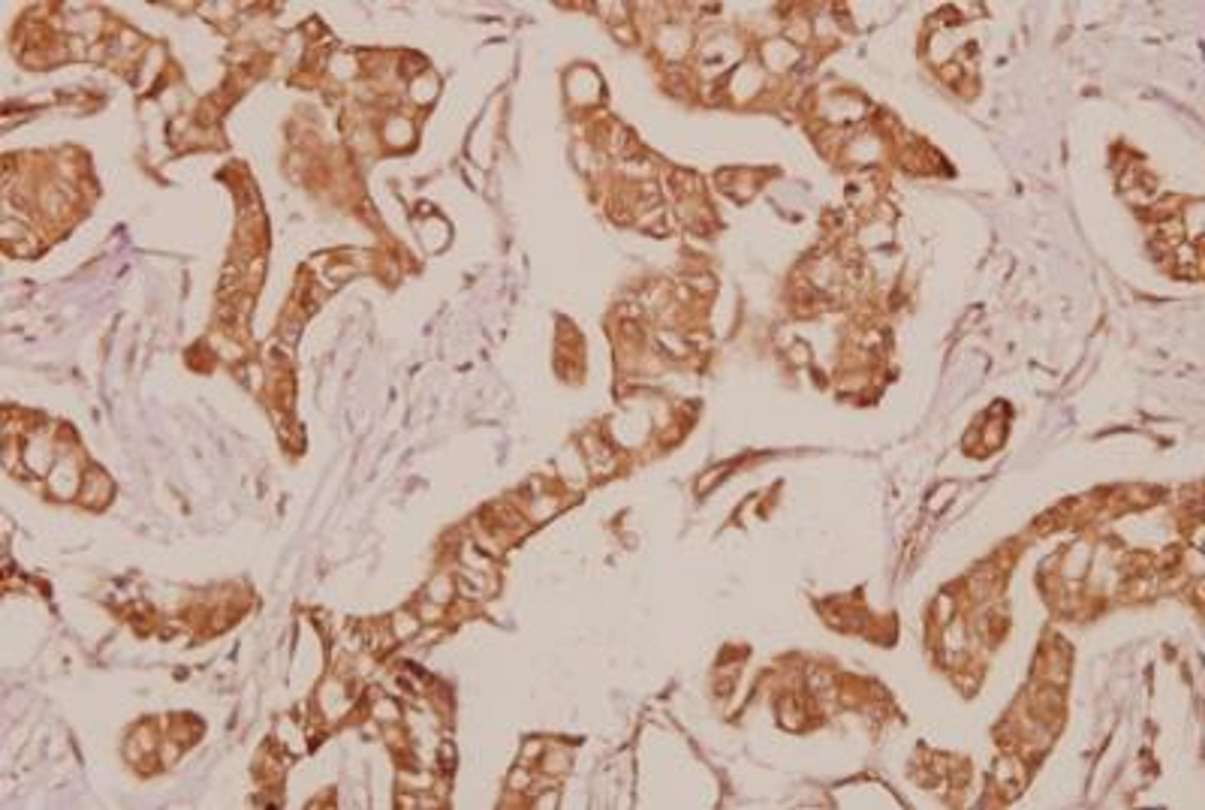 Immunohistochemistry-Paraffin: PDGF R alpha Antibody [NBP1-19423] - Paraffin-embedded human breast carcinoma tissue at 1:50.