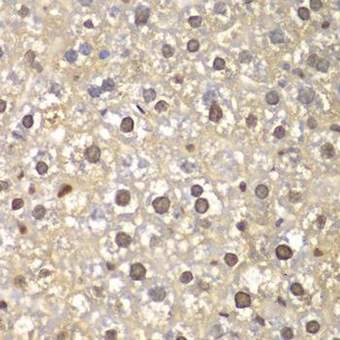 Immunohistochemical staining of human lung cancer tissue using FEN1 antibody (dilution of 1:100)