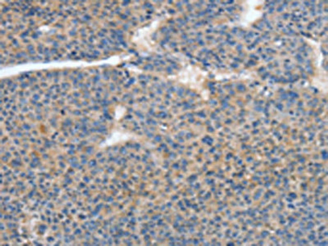 The image on the left is immunohistochemistry of paraffin-embedded Human liver cancer tissue using CSB-PA017108(ATP4B Antibody) at dilution 1/40, on the right is treated with fusion protein. (Original magnification: ×200)