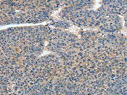 The image on the left is immunohistochemistry of paraffin-embedded Human liver cancer tissue using CSB-PA017108(ATP4B Antibody) at dilution 1/40, on the right is treated with fusion protein. (Original magnification: ×200)