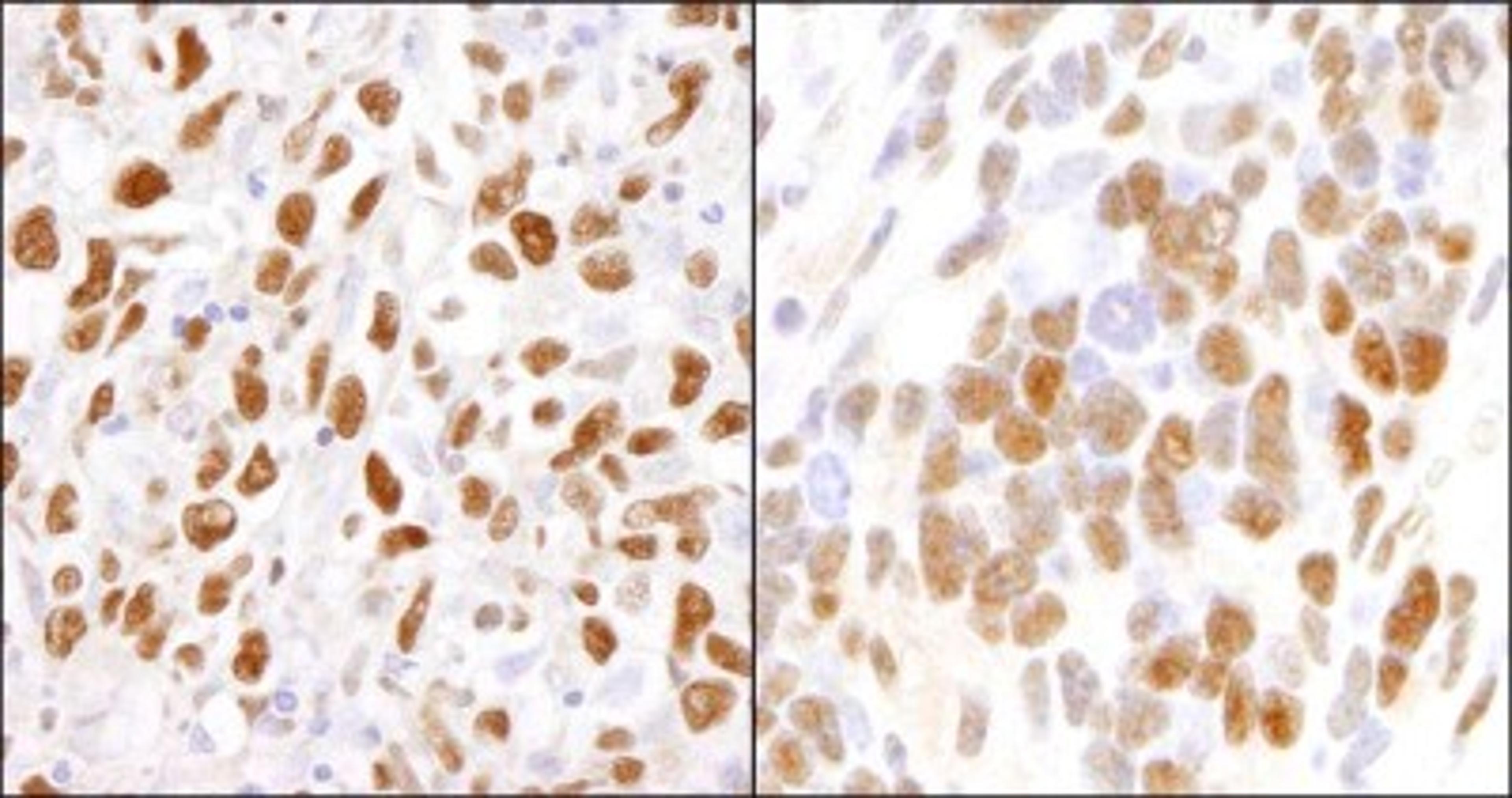 Immunohistochemistry-Paraffin: DDX5 Antibody [NB200-351] - Human metastatic lymph node (left) and mouse teratoma (right).  Antibody used at a dilution of 1:200 (1ug/ml).