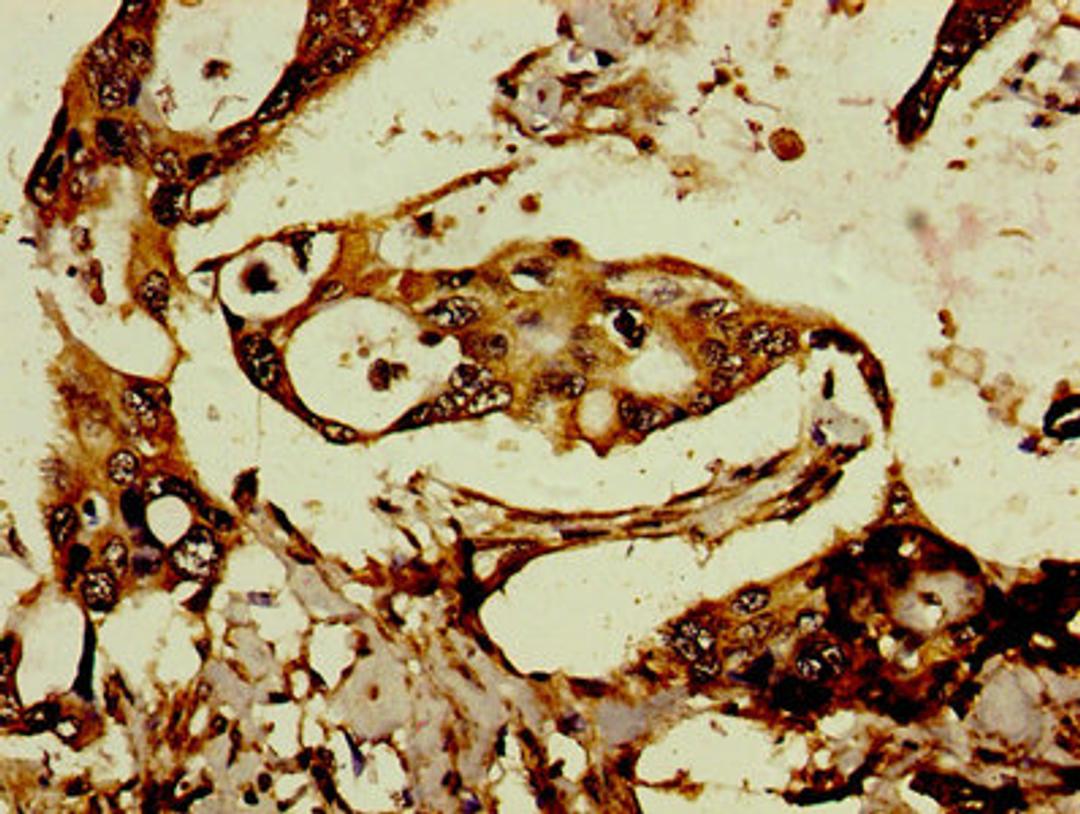 Immunohistochemistry of paraffin-embedded human pancreatic cancer using CSB-PA008044LA01HU at dilution of 1:100