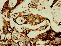 Immunohistochemistry of paraffin-embedded human pancreatic cancer using CSB-PA008044LA01HU at dilution of 1:100