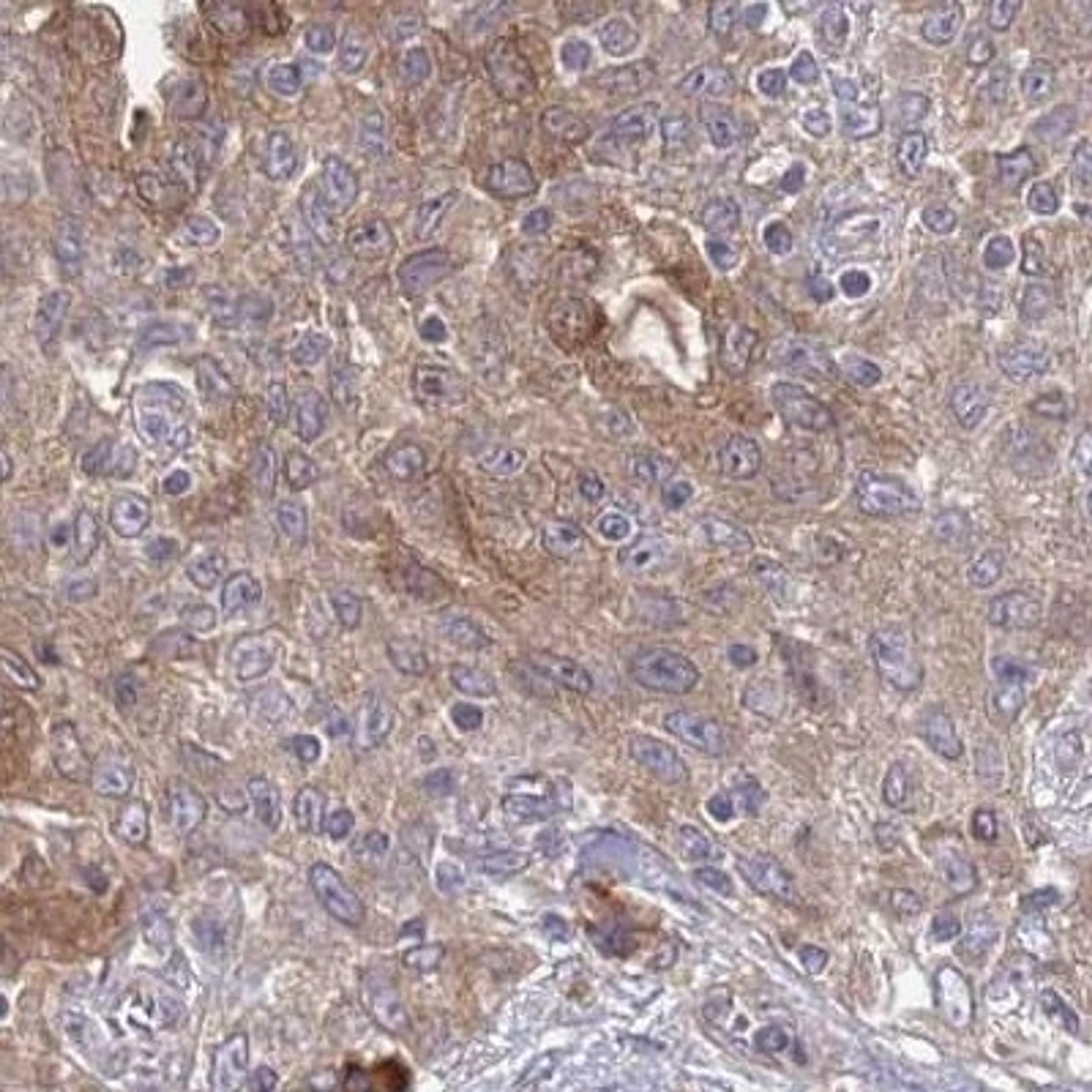 Immunohistochemistry: SULT2B1 Antibody [NBP2-32596] - lung cancer