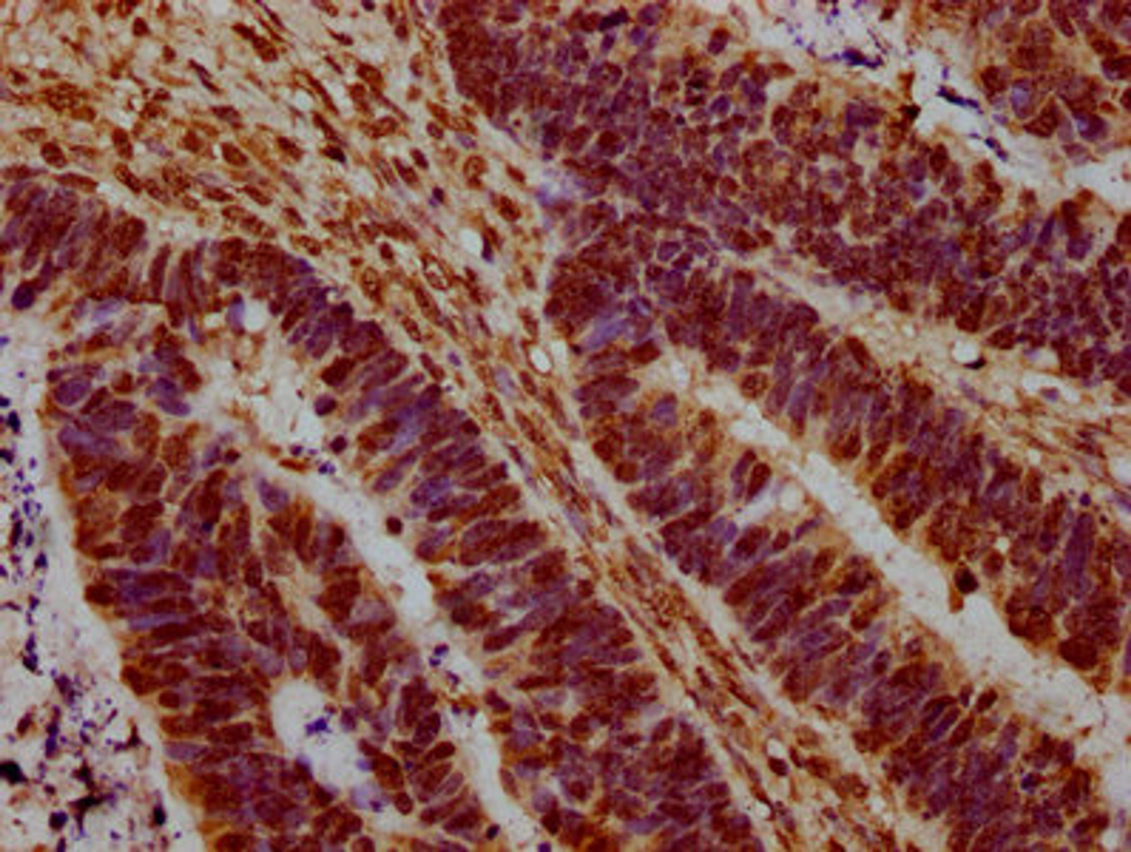 IHC image of CSB-PA010378OA45nme1HU diluted at 1:20 and staining in paraffin-embedded human ovarian cancer performed on a Leica BondTM system. After dewaxing and hydration, antigen retrieval was mediated by high pressure in a citrate buffer (pH 6.0). Section was blocked with 10% normal goat serum 30min at RT. Then primary antibody (1% BSA) was incubated at 4°C overnight. The primary is detected by a biotinylated secondary antibody and visualized using an HRP conjugated SP system.