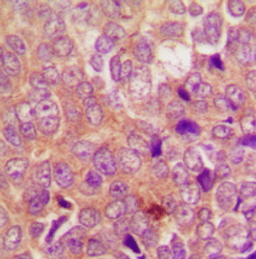 Immunohistochemical staining of human breast cancer using UBR1 antibody