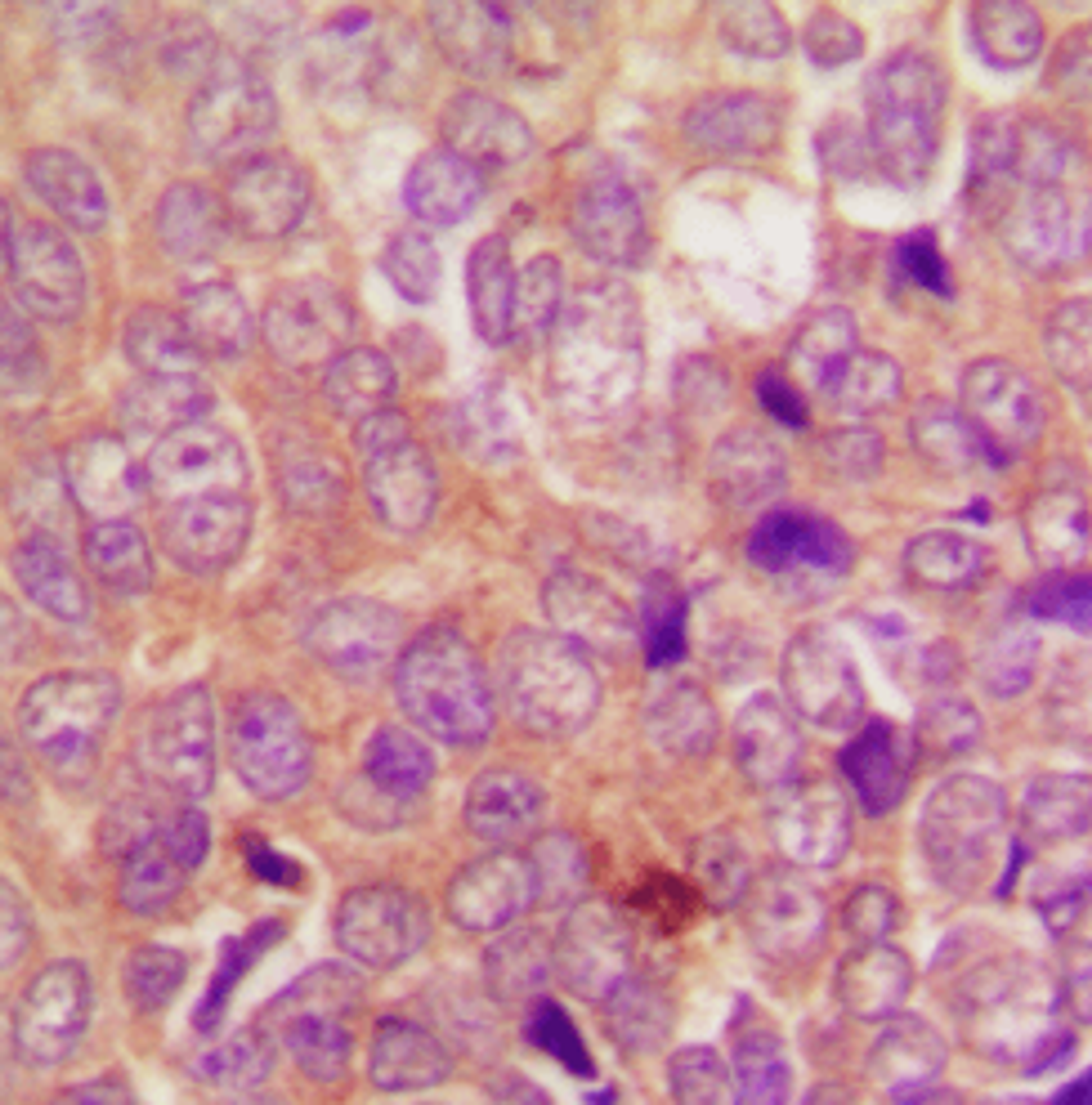 Immunohistochemical staining of human breast cancer using UBR1 antibody