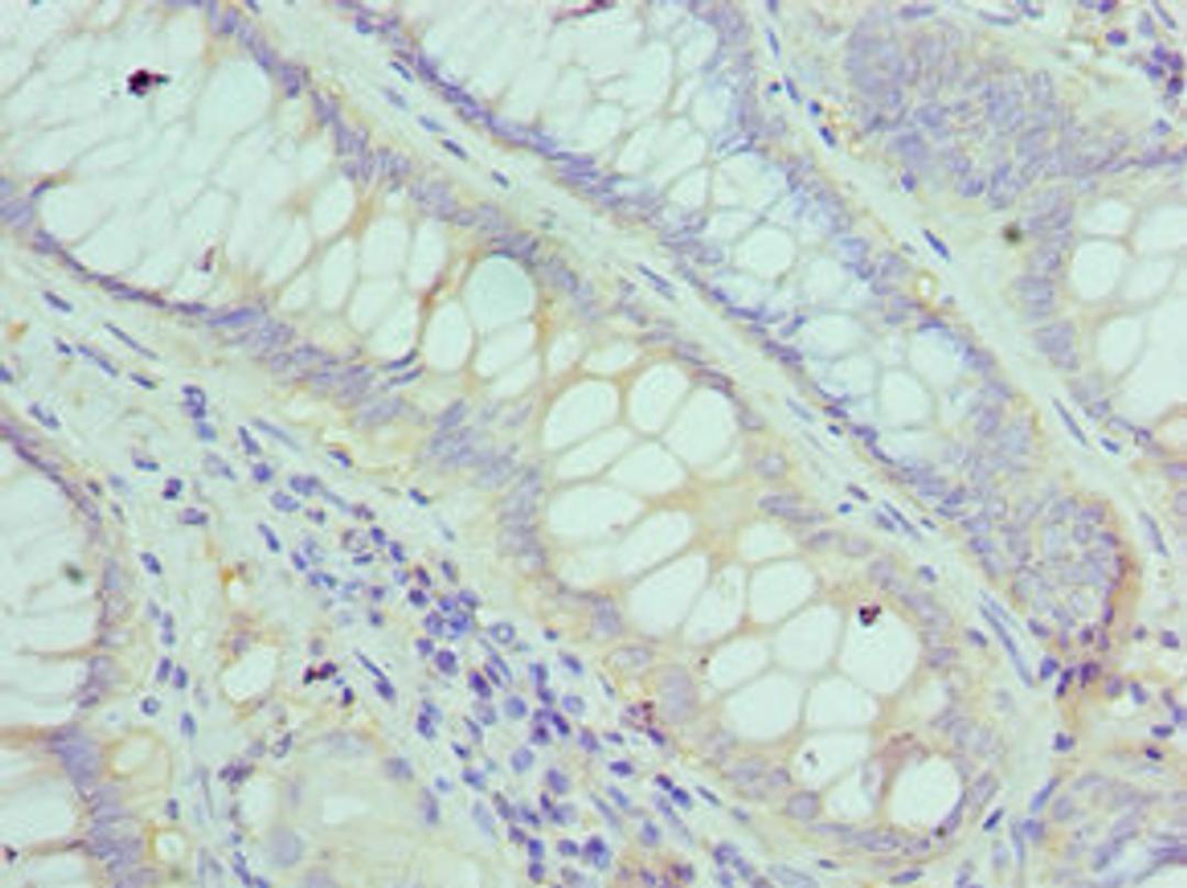 Immunohistochemistry of paraffin-embedded human colon cancer using CSB-PA008615ESR2HU at dilution of 1:100