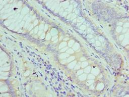 Immunohistochemistry of paraffin-embedded human colon cancer using CSB-PA008615ESR2HU at dilution of 1:100