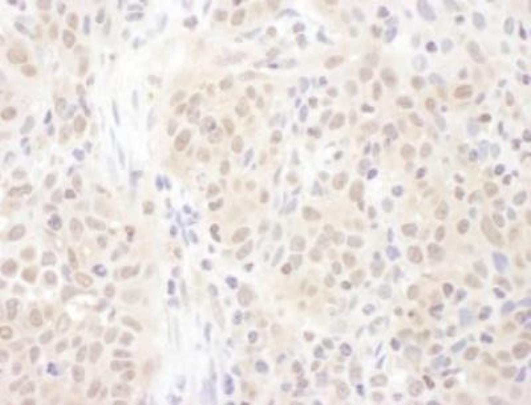 Immunohistochemistry-Paraffin: PSME4 Antibody [NBP2-22236] - FFPE section of human non-small cell lung cancer. Antibody: Affinity purified rabbit anti-PSME4 used at a dilution of 1:1,000 (1ug/ml). Detection: DAB. Counterstain: Hematoxylin (blue).