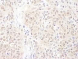 Immunohistochemistry-Paraffin: PSME4 Antibody [NBP2-22236] - FFPE section of human non-small cell lung cancer. Antibody: Affinity purified rabbit anti-PSME4 used at a dilution of 1:1,000 (1ug/ml). Detection: DAB. Counterstain: Hematoxylin (blue).