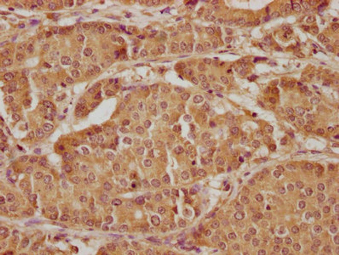 IHC image of CSB-PA012536LA01HU diluted at 1:300 and staining in paraffin-embedded human gastric cancer performed on a Leica BondTM system. After dewaxing and hydration, antigen retrieval was mediated by high pressure in a citrate buffer (pH 6.0). Section was blocked with 10% normal goat serum 30min at RT. Then primary antibody (1% BSA) was incubated at 4°C overnight. The primary is detected by a biotinylated secondary antibody and visualized using an HRP conjugated SP system.