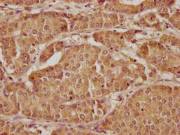 IHC image of CSB-PA012536LA01HU diluted at 1:300 and staining in paraffin-embedded human gastric cancer performed on a Leica BondTM system. After dewaxing and hydration, antigen retrieval was mediated by high pressure in a citrate buffer (pH 6.0). Section was blocked with 10% normal goat serum 30min at RT. Then primary antibody (1% BSA) was incubated at 4°C overnight. The primary is detected by a biotinylated secondary antibody and visualized using an HRP conjugated SP system.
