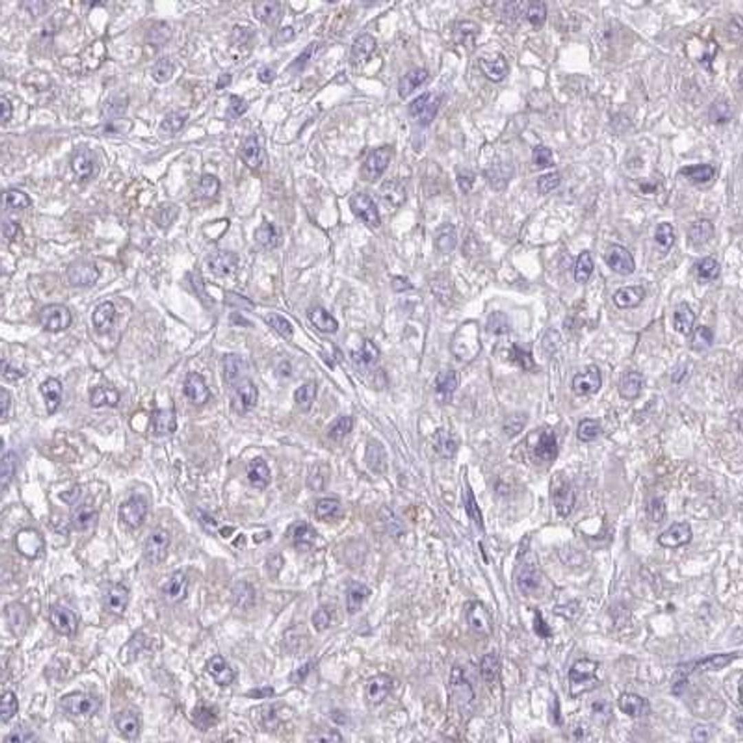 Immunohistochemistry: RNF183 Antibody [NBP2-31683] - liver cancer