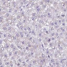 Immunohistochemistry: RNF183 Antibody [NBP2-31683] - liver cancer